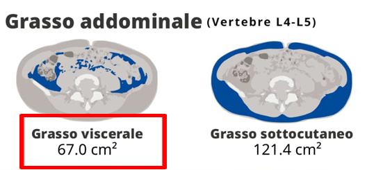 Abdominal Visceral Fat